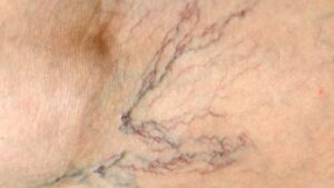 What Are Spider Veins?