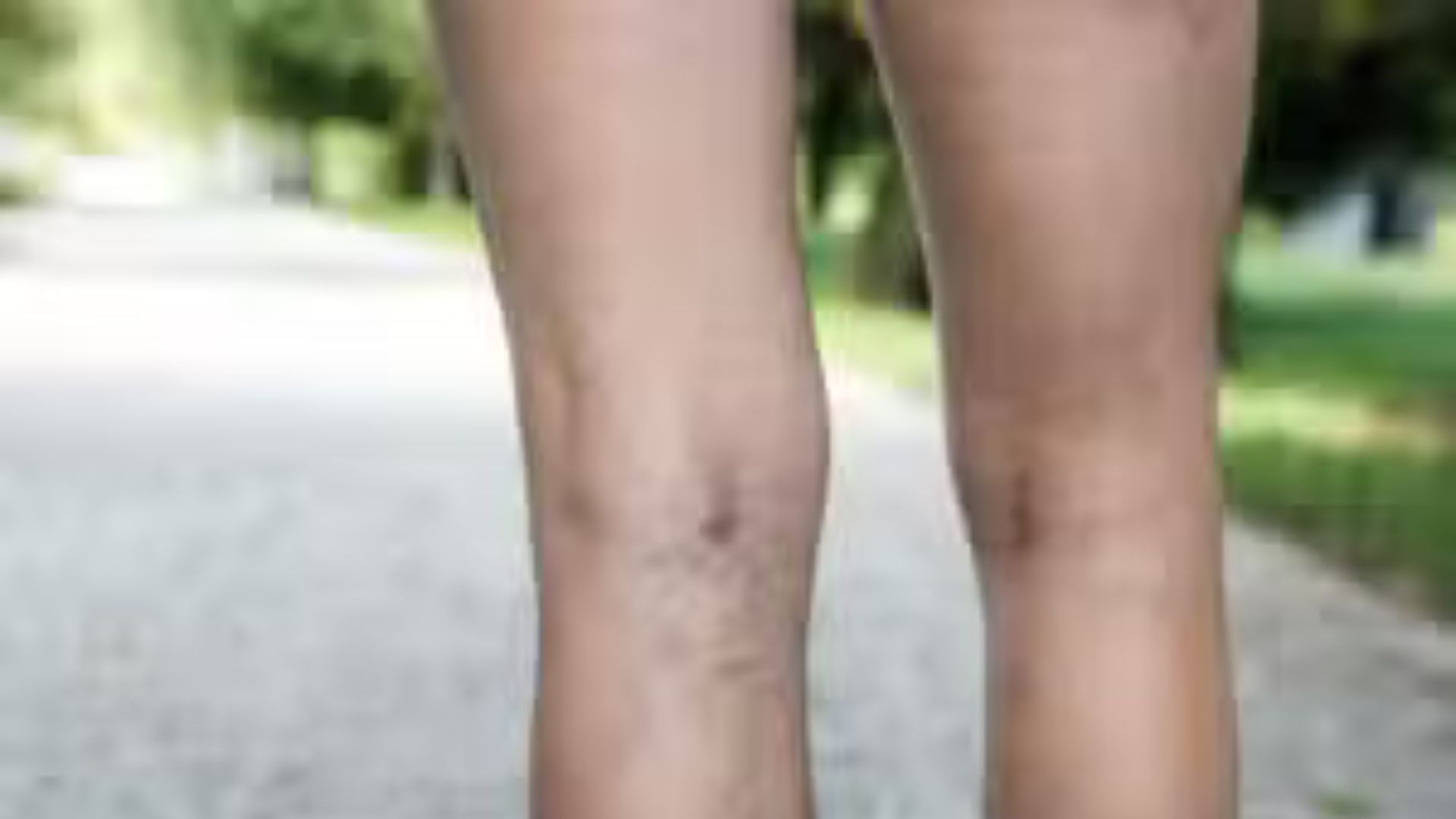 What Causes Spider Veins?